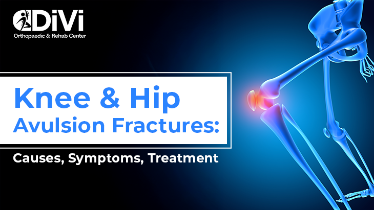 Knee and Hip Avulsion Fracture: Causes, Symptoms, Treatment