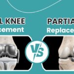 Total knee replacement vs partial knee replacement implant comparison – Divi Orthopaedic & Rehab Center | Mumbai