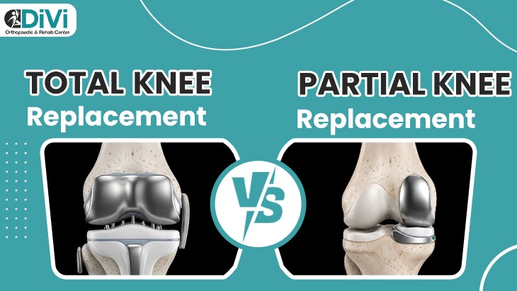 Total knee replacement vs partial knee replacement implant comparison – Divi Orthopaedic & Rehab Center | Mumbai