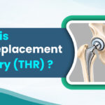 Hip replacement surgery (THR) showing artificial hip joint