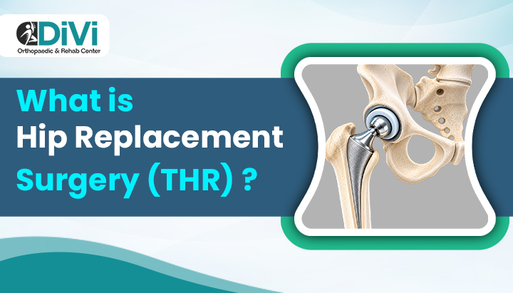 Total Hip Replacement Surgery Hip replacement surgery (THR) showing artificial hip joint